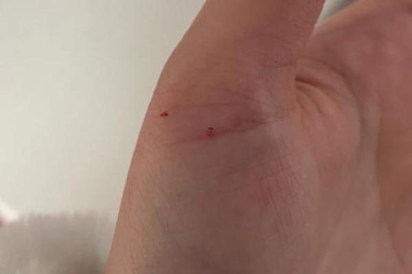 梦见被猫咬手